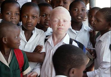 albinoafrica